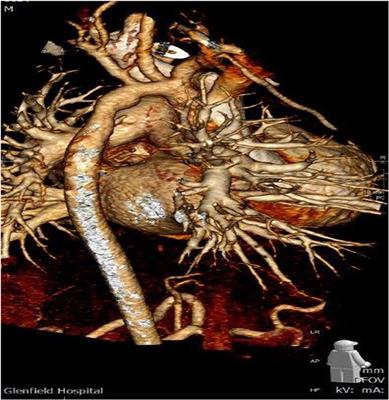 Is Decellularized Porcine Small Intestine Sub-mucosa Patch Suitable for Aortic Arch Repair?